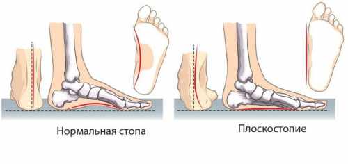 Плоскостопие: описание, причины, симптомы, лечение