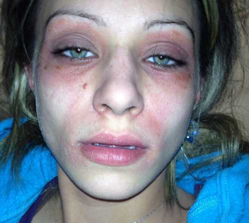 Причины аллергии на глазах симптомы и лечение