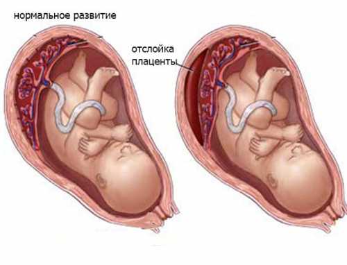 Отслойка плаценты