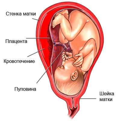 На месте бывшего ее прикрепления к матке могут образовываться отложения солей