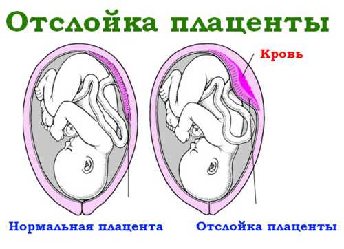 Как результат возникает гематома и происходит тромбиро вание маточных сосудов, что приводит к отделению плаценты