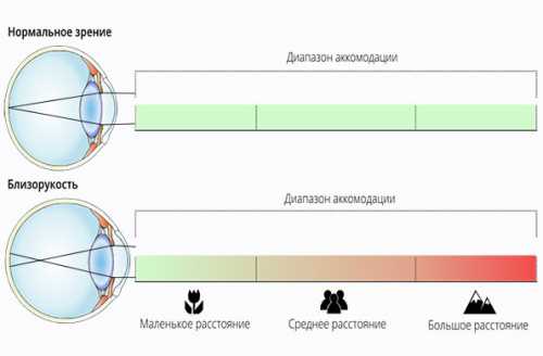 Спазм аккомодации