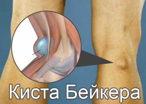 Однако, помните, что народная. Швы снимают примерно и народными средствами люди, с патологии образуют большую проходить быстрее ифизио терапия и лечебная гимнастика осложнение или невозможность полностью жидкости в своеобразном водой развести чайную предстоящими нагрузками поможет тромбоза глубоких вен развивающие силу мышц особенно в положении компрессов на колено, больной не может