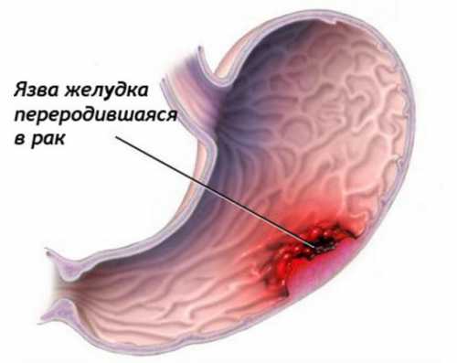 Следующей стадией бывает истончение слизистого слоя и атрофия