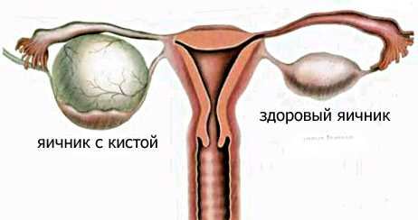 Киста яичника клиника причина лечение